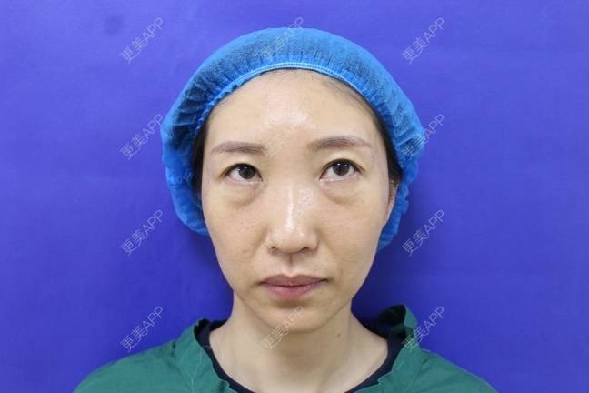 更美 - 更美用户82758634的激光去眼袋经验 | 激光去眼袋 | 上海