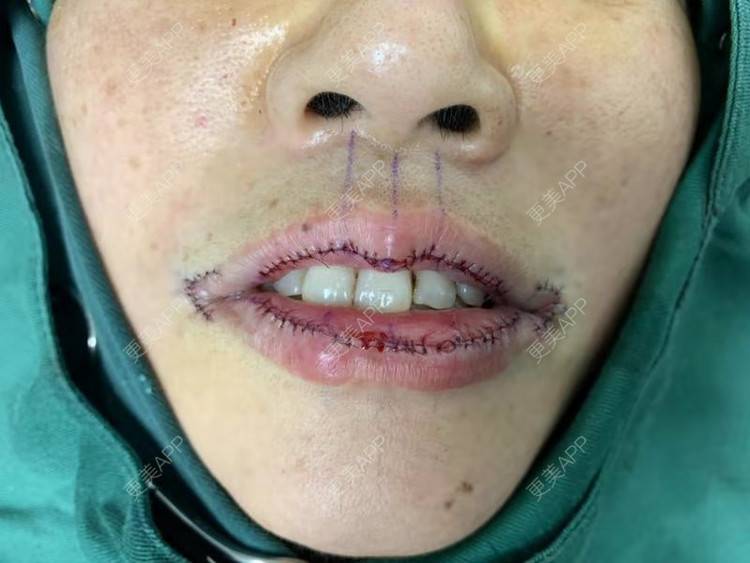 更美用户qi2k2gafam的厚唇改薄术日记