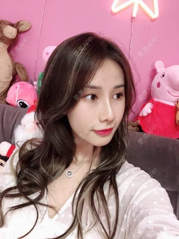 更美 - 七彩百香柠檬茶的鼻部多项经验 | 鼻小柱延长 | 自体软骨垫鼻尖 | 鼻部多项 | 重庆 | 硅胶隆鼻 | 肋软骨隆鼻 | 鼻翼缩小