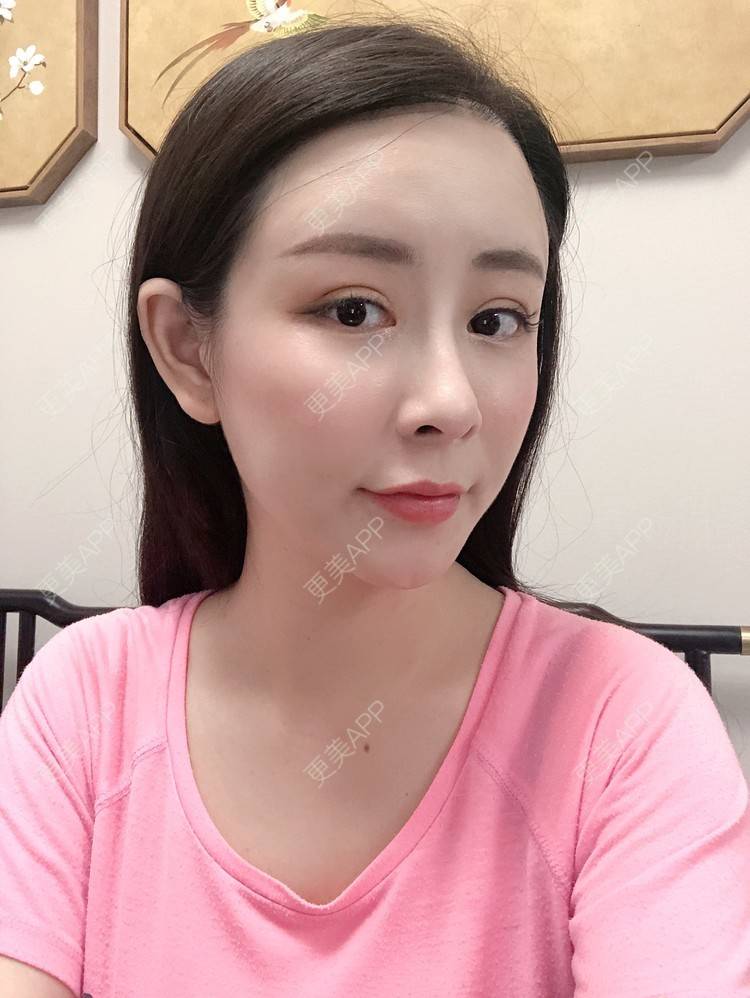 更美 - 兰质慧心的自体脂肪丰苹果肌经验 | 上海 | 视频日记 | 自体脂肪丰面颊 | 自体脂肪丰苹果肌 | 自体脂肪垫下巴