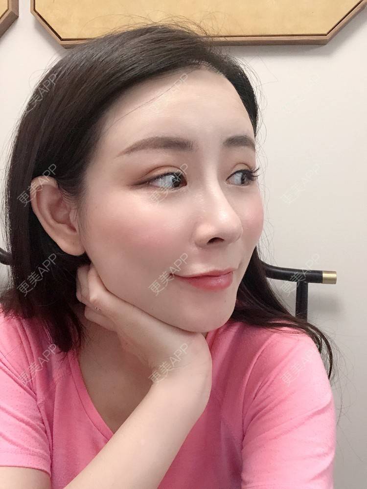 更美 - 兰质慧心的自体脂肪丰苹果肌经验 | 上海 | 视频日记 | 自体脂肪丰面颊 | 自体脂肪丰苹果肌 | 自体脂肪垫下巴