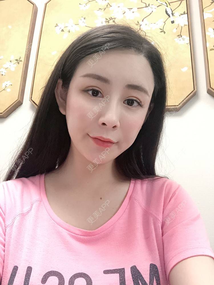 更美 - 兰质慧心的自体脂肪丰苹果肌经验 | 上海 | 视频日记 | 自体脂肪丰面颊 | 自体脂肪丰苹果肌 | 自体脂肪垫下巴