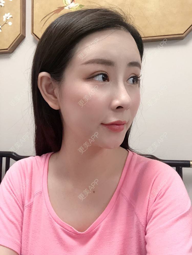 更美 - 兰质慧心的自体脂肪丰苹果肌经验 | 上海 | 视频日记 | 自体脂肪丰面颊 | 自体脂肪丰苹果肌 | 自体脂肪垫下巴