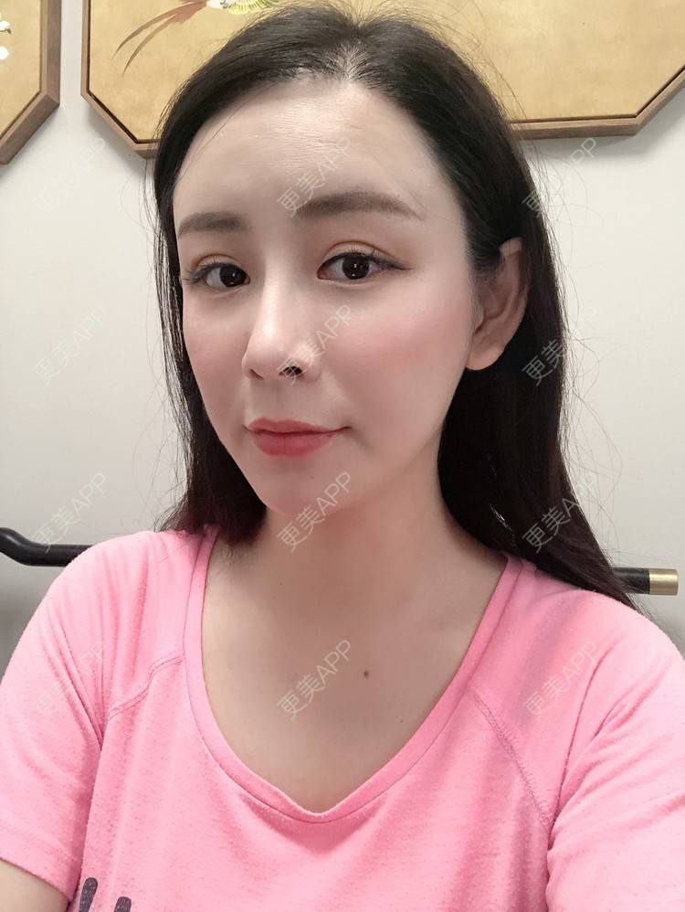 更美 - 兰质慧心的自体脂肪丰苹果肌经验 | 上海 | 视频日记 | 自体脂肪丰面颊 | 自体脂肪丰苹果肌 | 自体脂肪垫下巴
