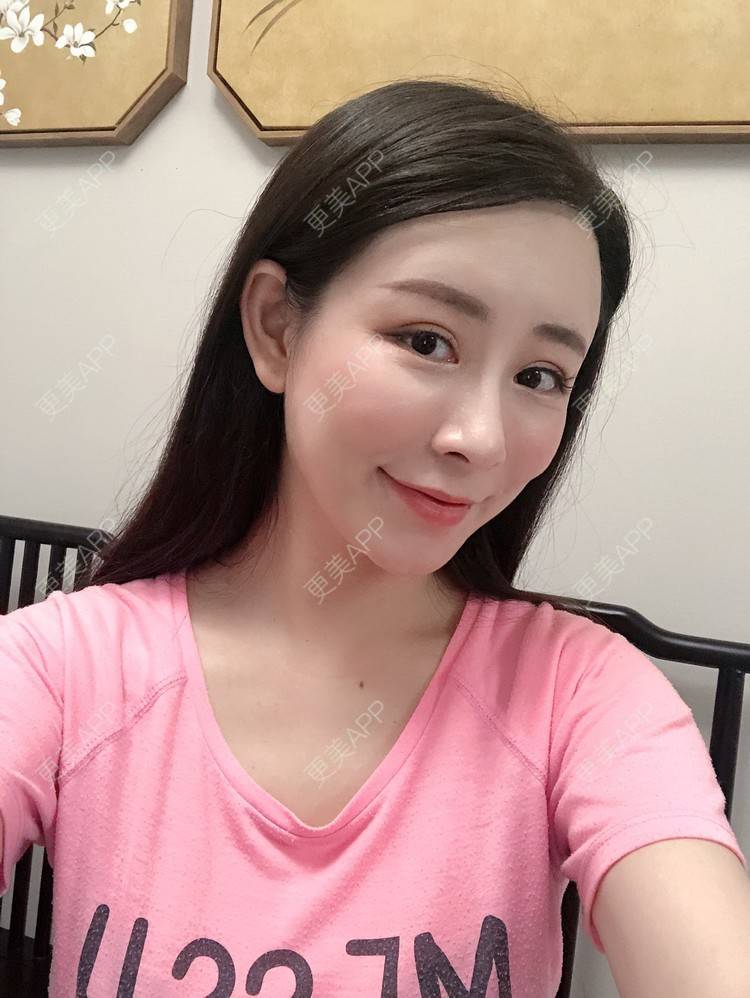 更美 - 兰质慧心的自体脂肪丰苹果肌经验 | 上海 | 视频日记 | 自体脂肪丰面颊 | 自体脂肪丰苹果肌 | 自体脂肪垫下巴
