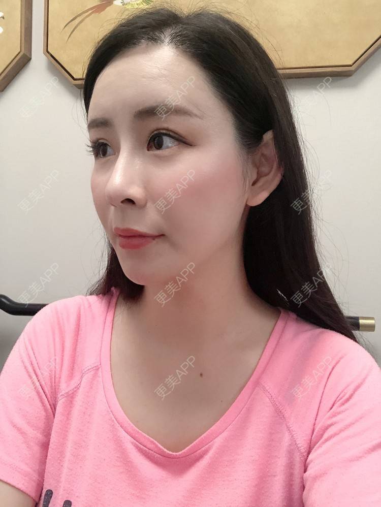 更美 - 兰质慧心的自体脂肪丰苹果肌经验 | 上海 | 视频日记 | 自体脂肪丰面颊 | 自体脂肪丰苹果肌 | 自体脂肪垫下巴