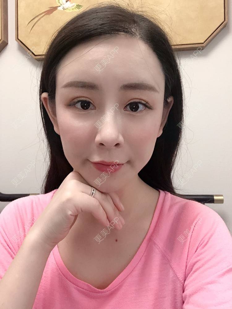 更美 - 兰质慧心的自体脂肪丰苹果肌经验 | 上海 | 视频日记 | 自体脂肪丰面颊 | 自体脂肪丰苹果肌 | 自体脂肪垫下巴