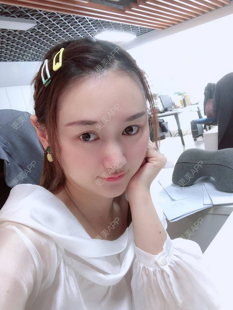 更美 - 小魅力的下巴经验 | 缩下巴 | 硅胶垫下巴 | 膨体垫下巴 | 宽下巴矫正 | 下巴 | 玻尿酸下巴 | 下巴截骨前移 | 自体脂肪垫下巴 | 人工骨垫下巴