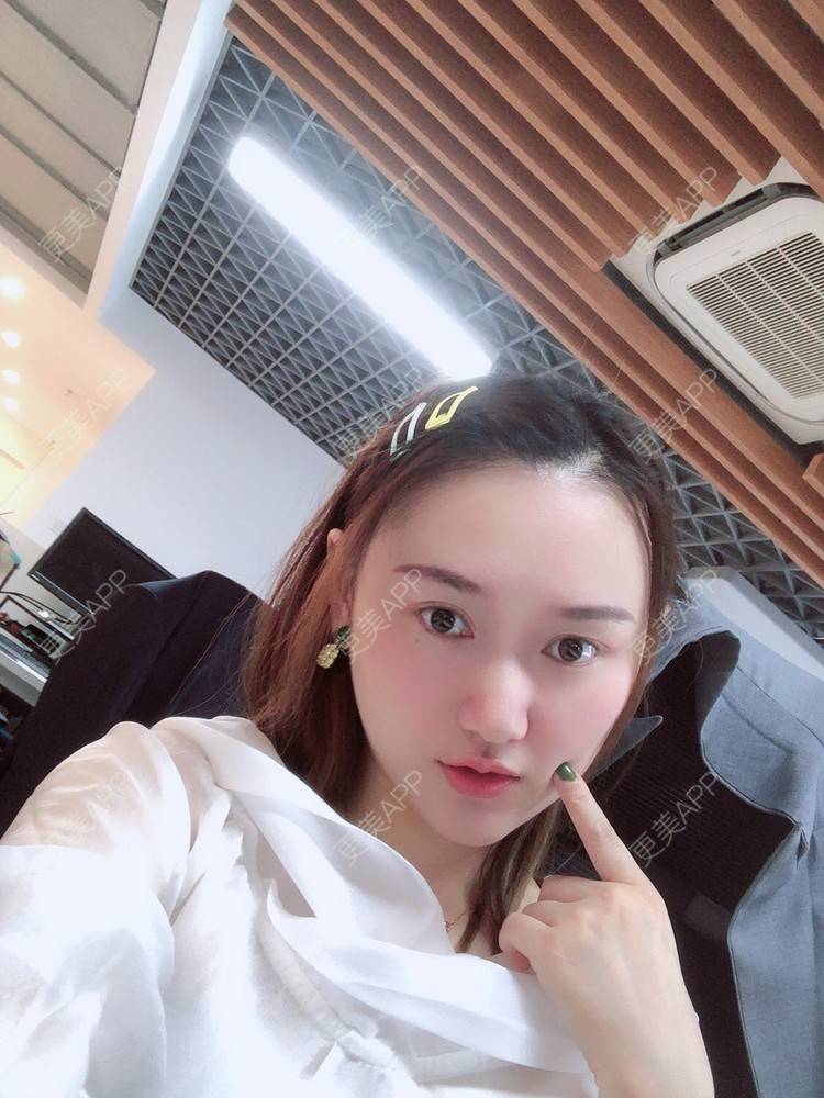 更美 - 小魅力的下巴经验 | 缩下巴 | 硅胶垫下巴 | 膨体垫下巴 | 宽下巴矫正 | 下巴 | 玻尿酸下巴 | 下巴截骨前移 | 自体脂肪垫下巴 | 人工骨垫下巴