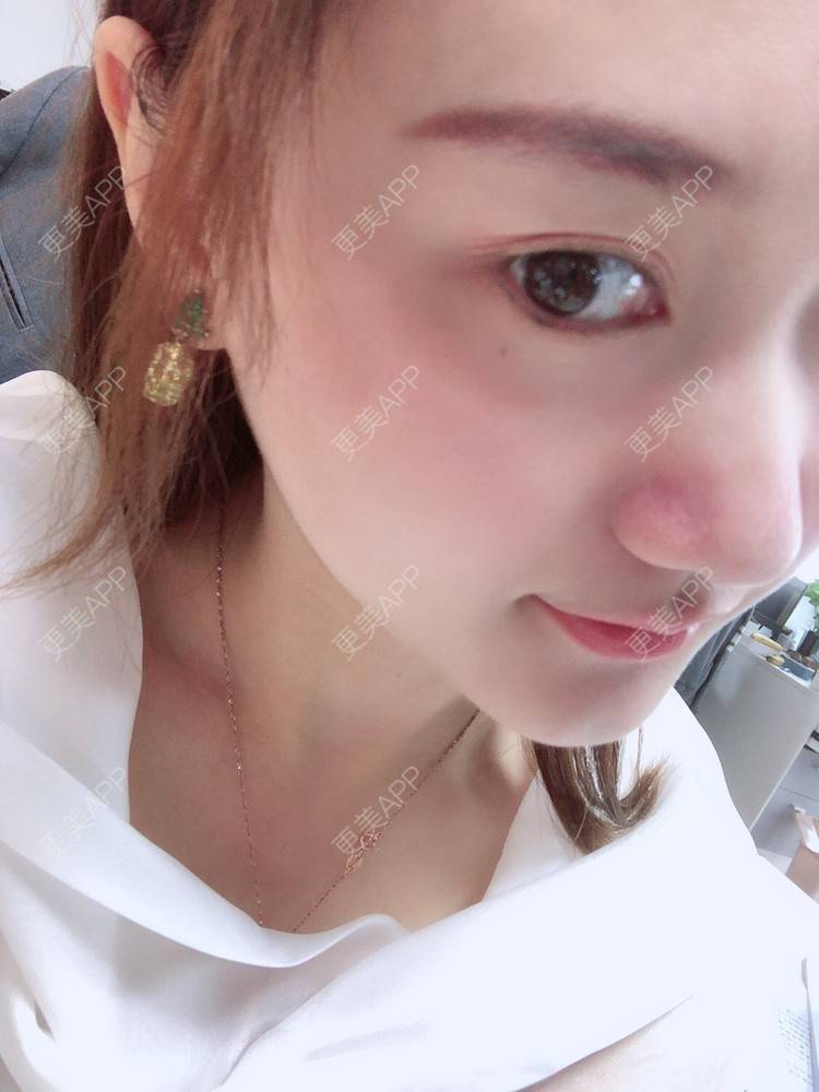 更美 - 小魅力的下巴经验 | 缩下巴 | 硅胶垫下巴 | 膨体垫下巴 | 宽下巴矫正 | 下巴 | 玻尿酸下巴 | 下巴截骨前移 | 自体脂肪垫下巴 | 人工骨垫下巴