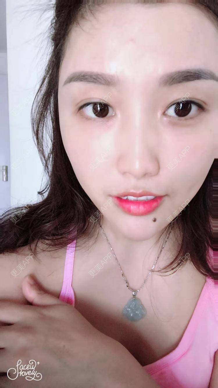 红妍m的玻尿酸下巴日记