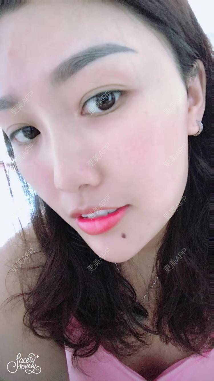 红妍m的玻尿酸下巴日记