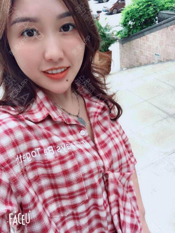 红妍m的玻尿酸下巴日记