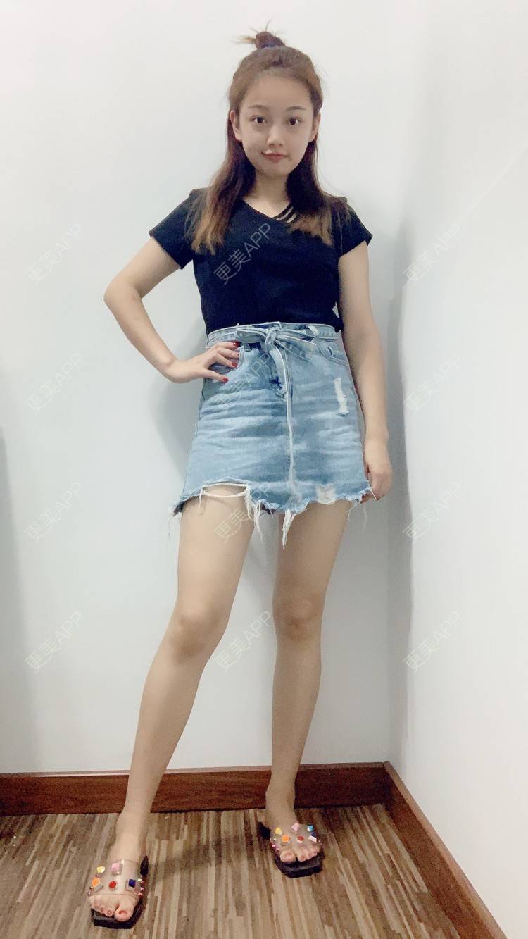 更美用户wjzs2oyqbj的吸脂瘦大腿日记