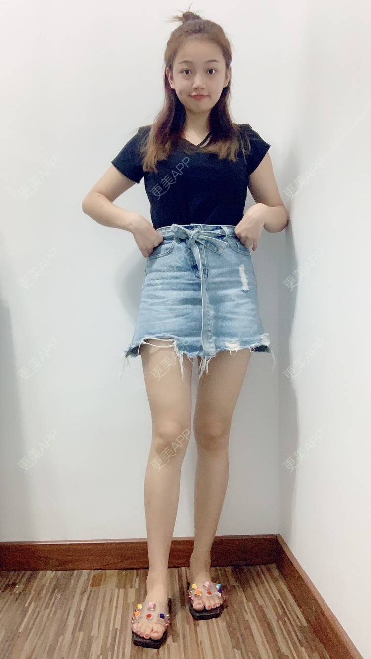 更美用户wjzs2oyqbj的吸脂瘦大腿日记