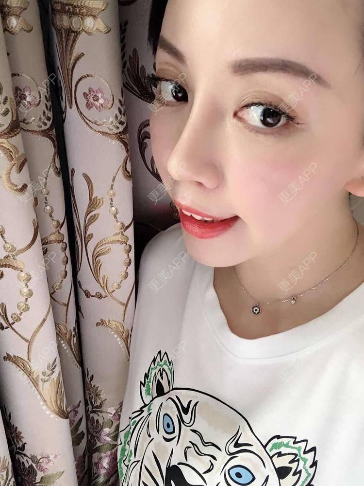 潇潇梧tong的隆鼻日记