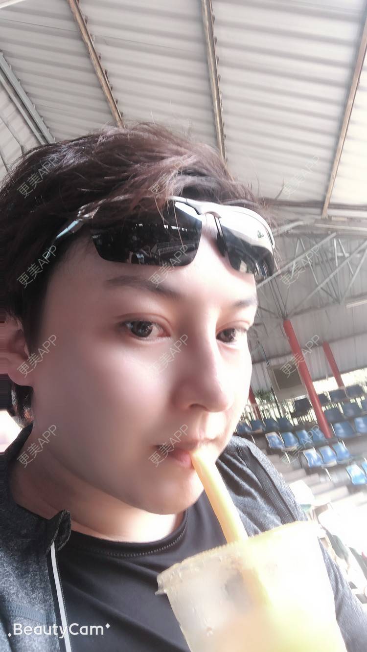 更美 - 杰教授的鼻形态修复经验 | 广州 | 鼻形态修复