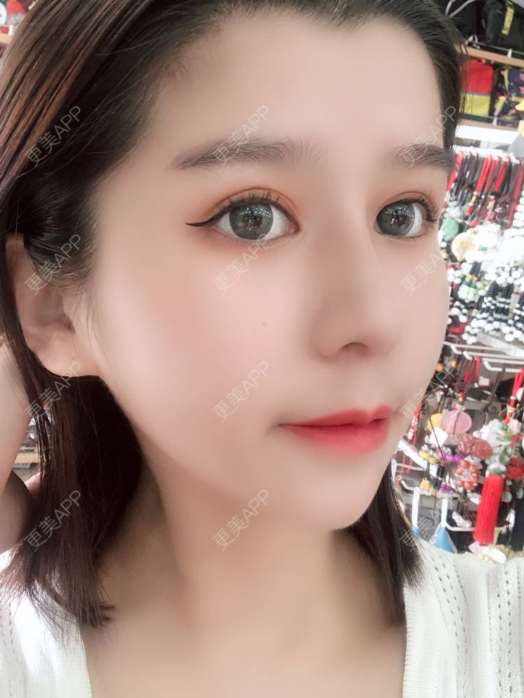 更美 - 更美用户9yYXeaKYPH的鼻部多项经验 | 鼻部多项 | 鼻中隔软骨垫鼻头 | 自体软骨垫鼻尖 | 鼻小柱缩短 | 肋软骨隆鼻