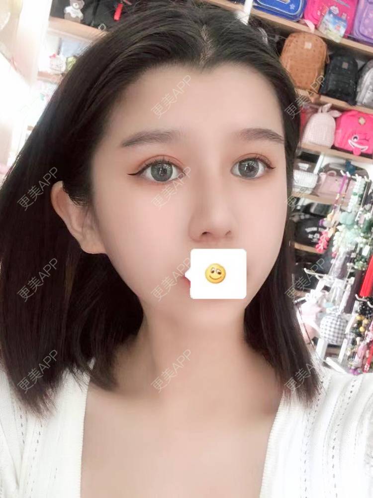 更美 - 更美用户9yYXeaKYPH的鼻部多项经验 | 鼻部多项 | 鼻中隔软骨垫鼻头 | 自体软骨垫鼻尖 | 鼻小柱缩短 | 肋软骨隆鼻