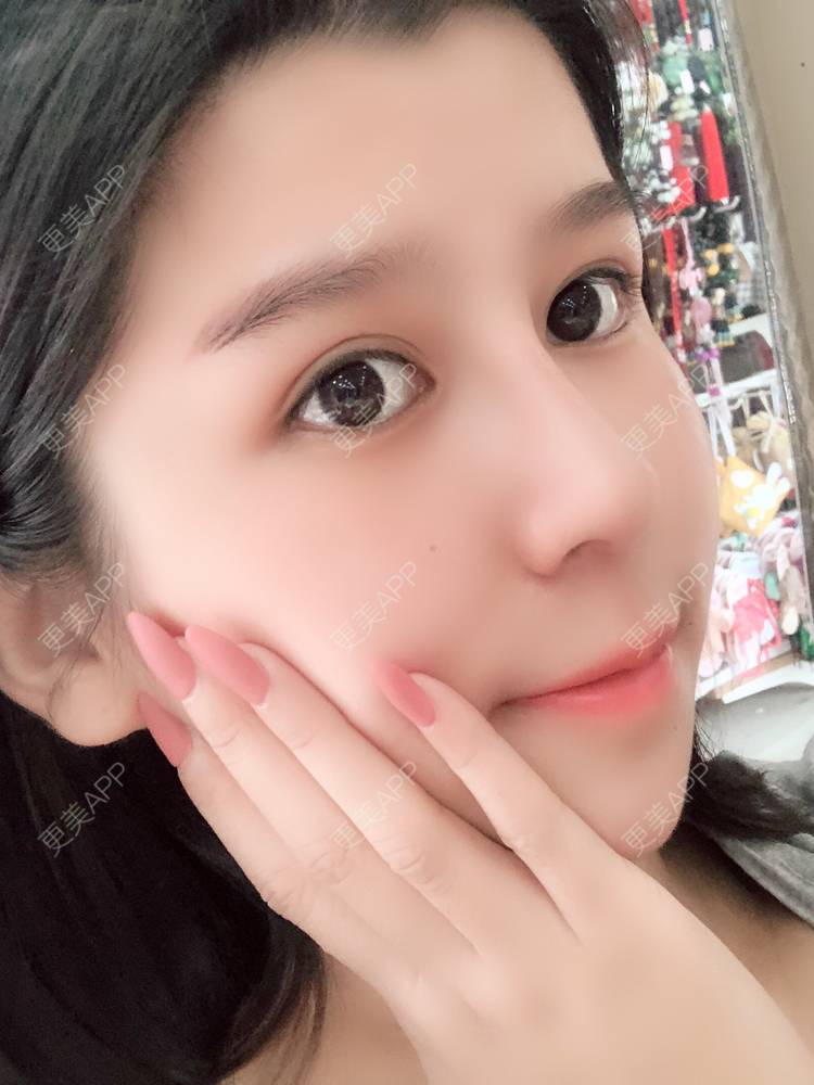 更美 - 更美用户9yYXeaKYPH的鼻部多项经验 | 鼻部多项 | 鼻中隔软骨垫鼻头 | 自体软骨垫鼻尖 | 鼻小柱缩短 | 肋软骨隆鼻