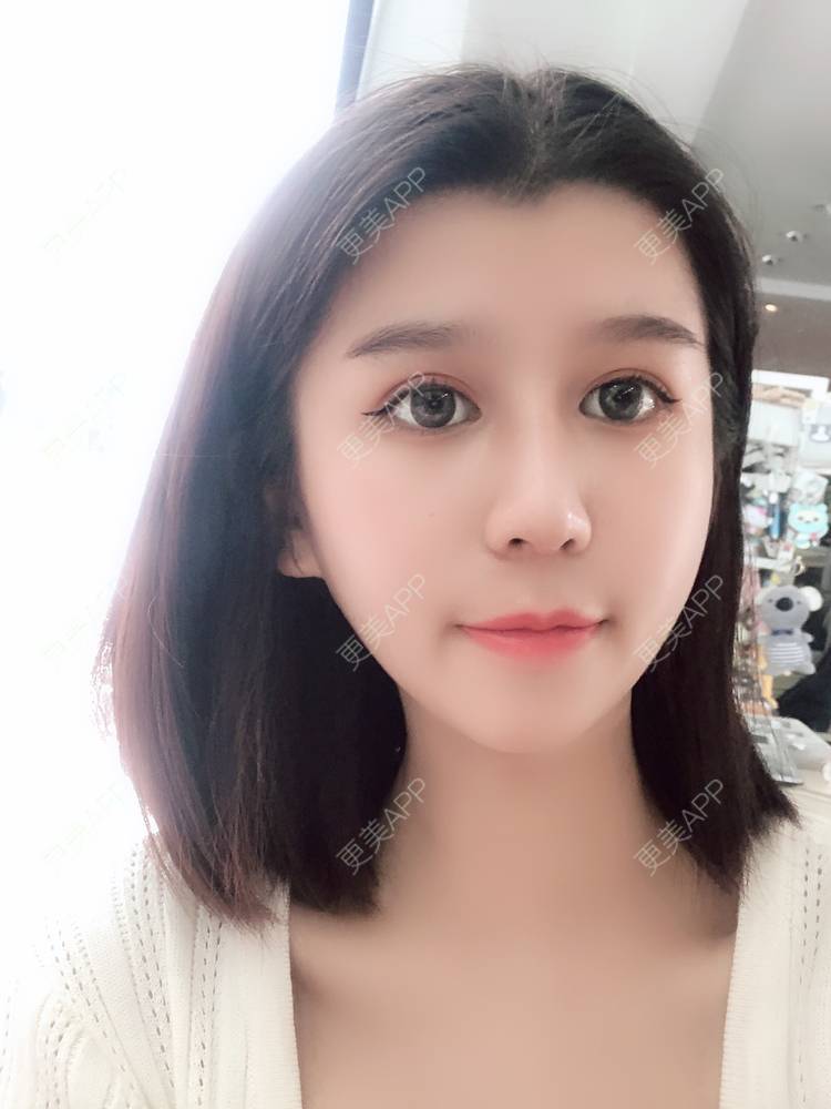更美 - 更美用户9yYXeaKYPH的鼻部多项经验 | 鼻部多项 | 鼻中隔软骨垫鼻头 | 自体软骨垫鼻尖 | 鼻小柱缩短 | 肋软骨隆鼻