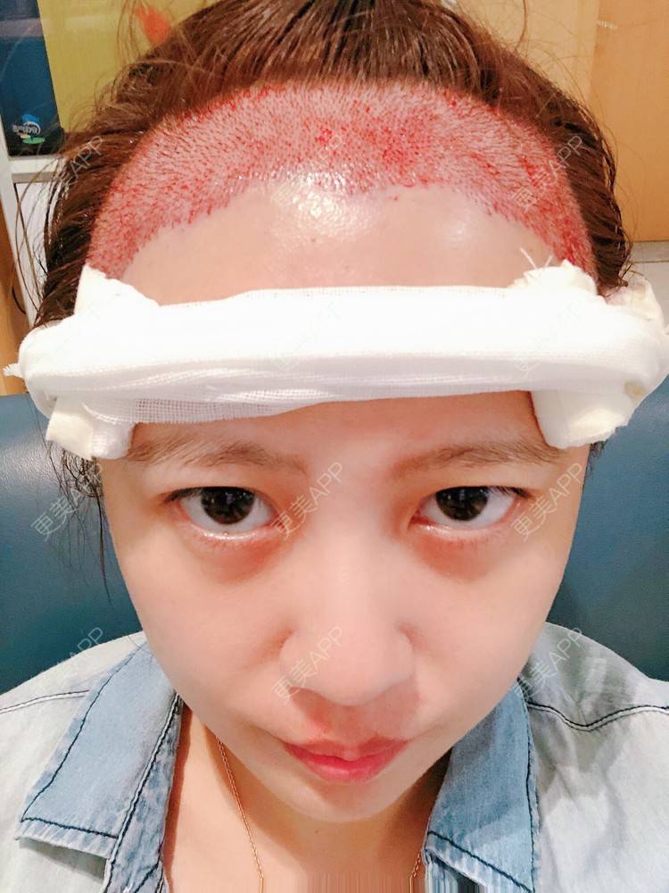 46的植发际线日记