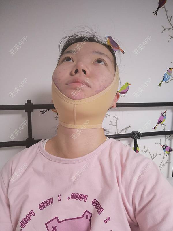 更美用户cjncgiz1ml的下颌角切除术日记