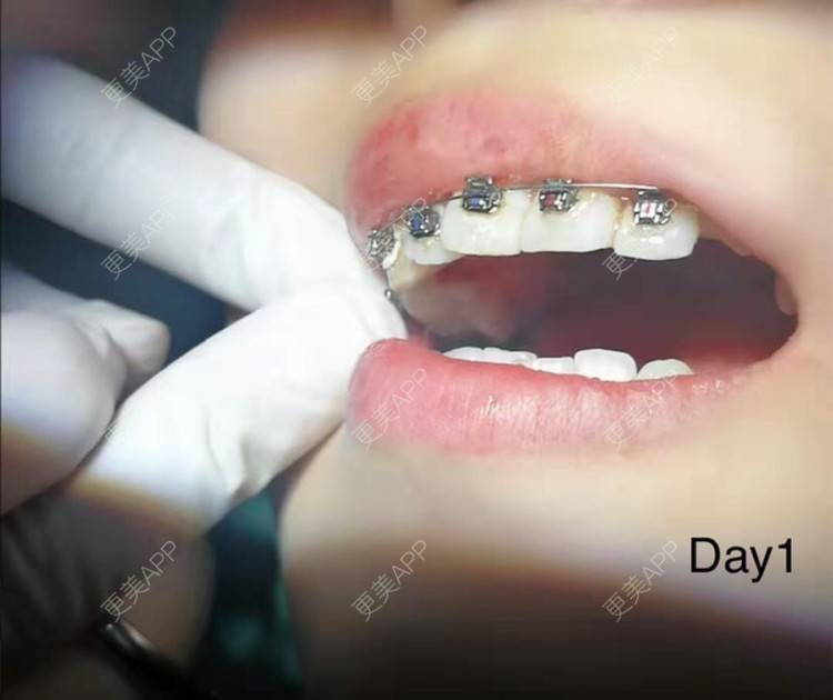 欧姐就不能飞的牙齿矫正日记