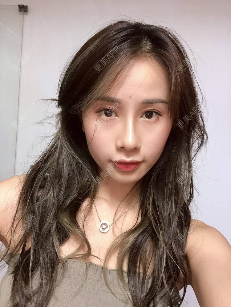 更美 - 七彩百香柠檬茶的鼻部多项经验 | 鼻小柱延长 | 自体软骨垫鼻尖 | 鼻部多项 | 重庆 | 硅胶隆鼻 | 肋软骨隆鼻 | 鼻翼缩小