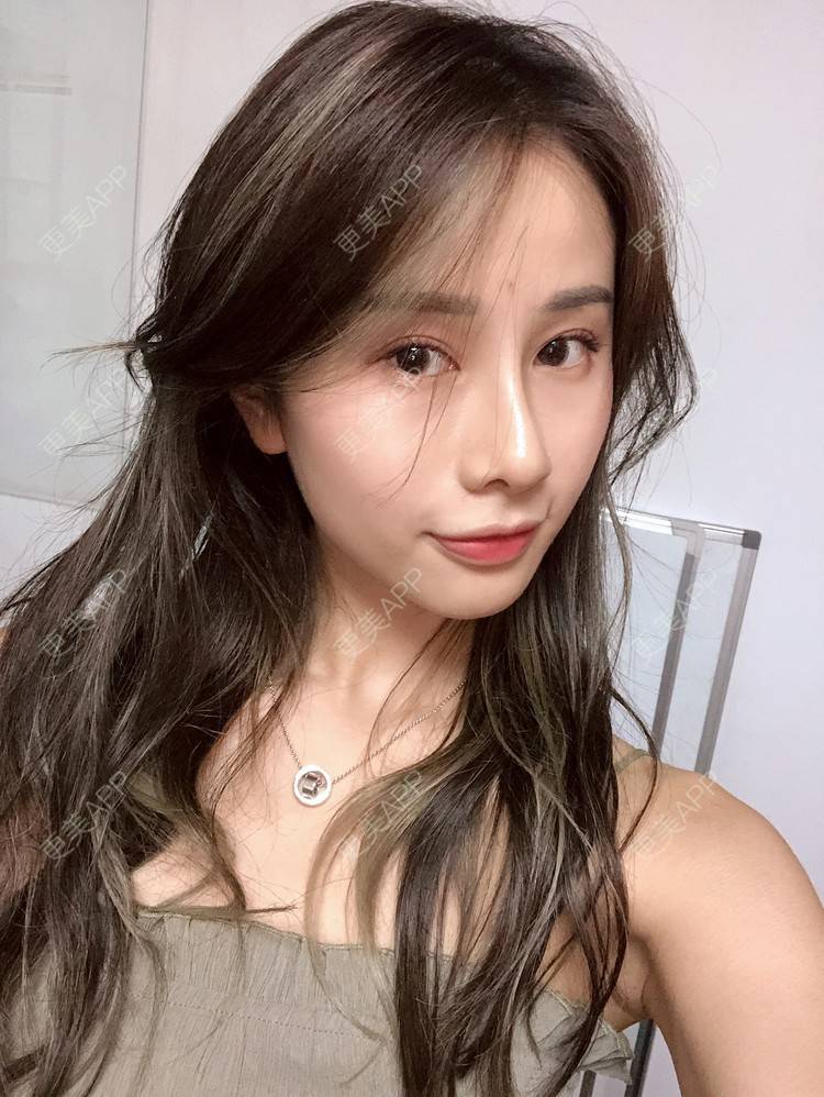 更美 - 七彩百香柠檬茶的鼻部多项经验 | 鼻小柱延长 | 自体软骨垫鼻尖 | 鼻部多项 | 重庆 | 硅胶隆鼻 | 肋软骨隆鼻 | 鼻翼缩小