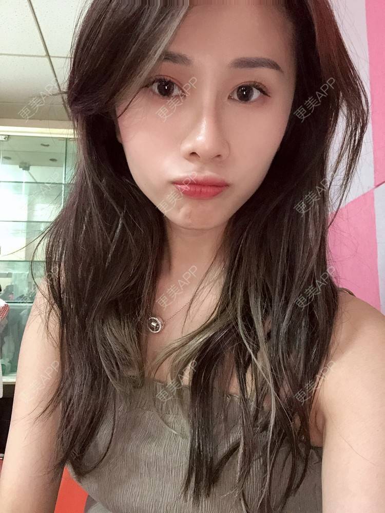 更美 - 七彩百香柠檬茶的鼻部多项经验 | 鼻小柱延长 | 自体软骨垫鼻尖 | 鼻部多项 | 重庆 | 硅胶隆鼻 | 肋软骨隆鼻 | 鼻翼缩小