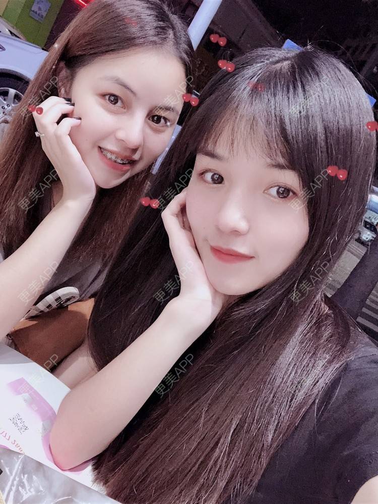 更美 - 更美用户fNYhXhfMuI的自体软骨垫鼻尖经验 | 自体软骨垫鼻尖 | 硅胶隆鼻 | 鼻小柱延长 | 耳软骨隆鼻