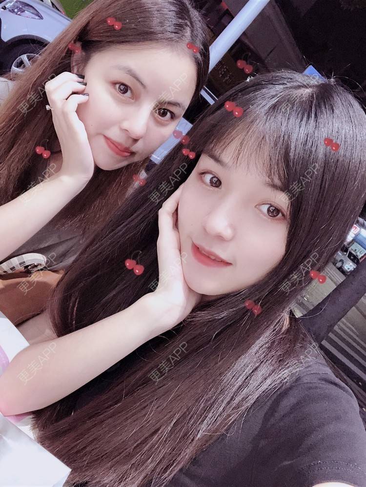 更美 - 更美用户fNYhXhfMuI的自体软骨垫鼻尖经验 | 自体软骨垫鼻尖 | 硅胶隆鼻 | 鼻小柱延长 | 耳软骨隆鼻