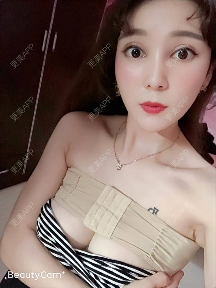 更美 - 穆大力 医生的假体隆胸经验 | 假体隆胸 | 广州