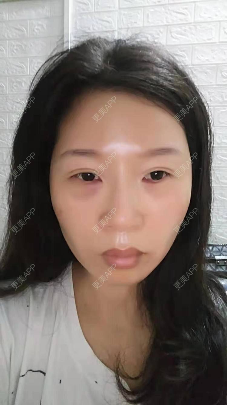 士多啤梨不要橙的激光去眼袋日记