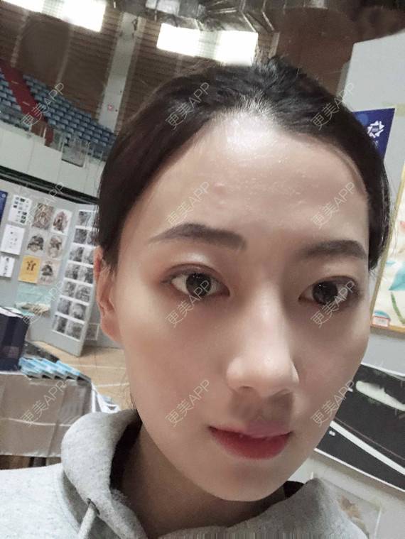 更美 - 更美用户rhLssoIYeR的热玛吉经验 | 超声提升 | 热拉提 | 深圳 | 热玛吉