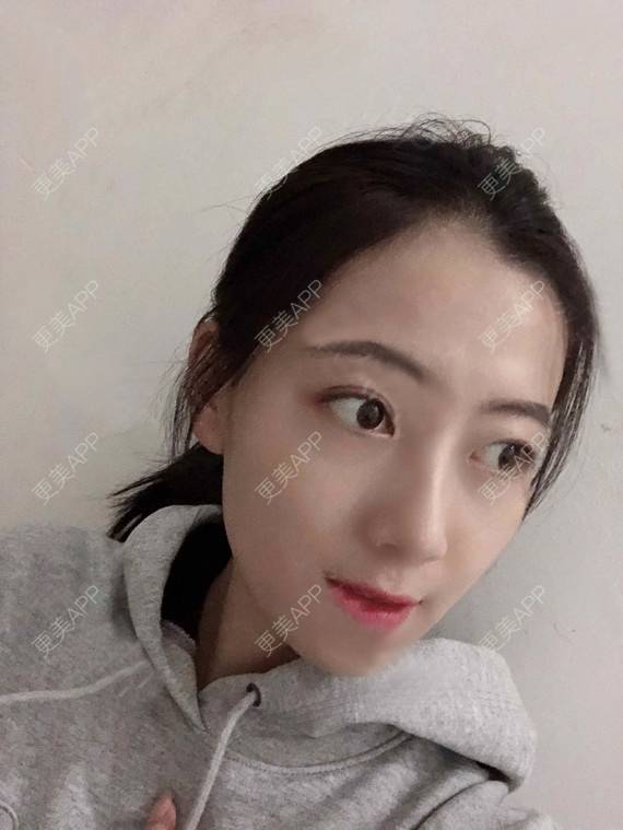 更美 - 更美用户rhLssoIYeR的热玛吉经验 | 超声提升 | 热拉提 | 深圳 | 热玛吉