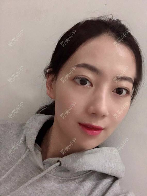 更美 - 更美用户rhLssoIYeR的热玛吉经验 | 超声提升 | 热拉提 | 深圳 | 热玛吉