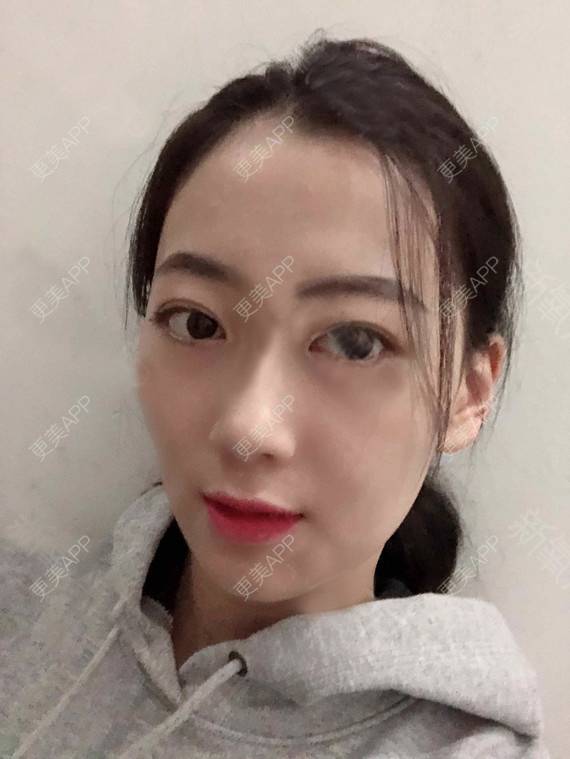 更美 - 更美用户rhLssoIYeR的热玛吉经验 | 超声提升 | 热拉提 | 深圳 | 热玛吉