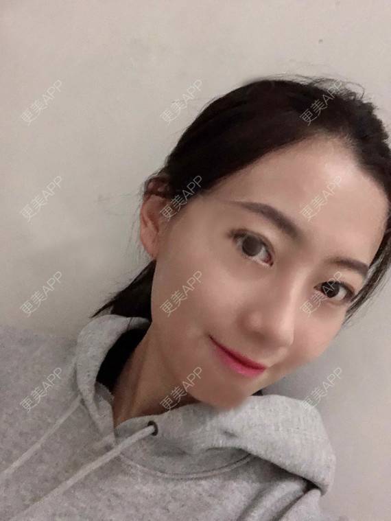 更美 - 更美用户rhLssoIYeR的热玛吉经验 | 超声提升 | 热拉提 | 深圳 | 热玛吉