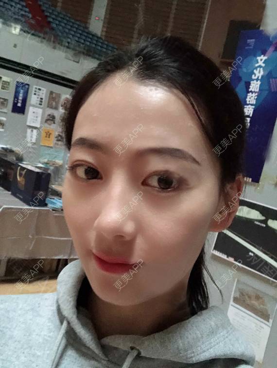 更美 - 更美用户rhLssoIYeR的热玛吉经验 | 超声提升 | 热拉提 | 深圳 | 热玛吉