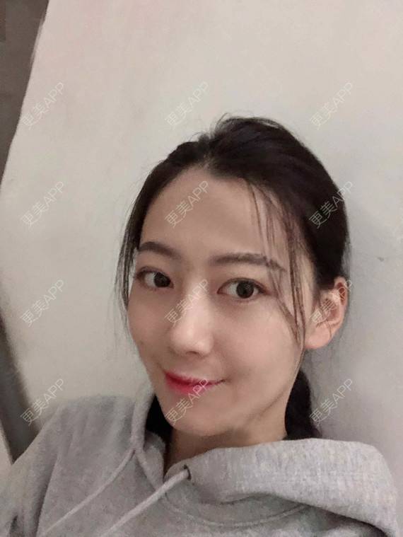 更美 - 更美用户rhLssoIYeR的热玛吉经验 | 超声提升 | 热拉提 | 深圳 | 热玛吉