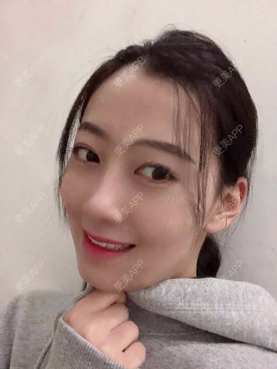 更美 - 更美用户rhLssoIYeR的热玛吉经验 | 超声提升 | 热拉提 | 深圳 | 热玛吉