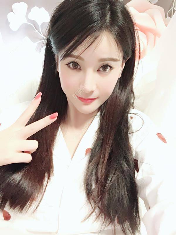 更美 - 肉圆子的酒窝经验 | 膨体垫下巴 | 自体脂肪垫下巴 | 硅胶垫下巴 | 人工骨垫下巴 | 酒窝 | 下巴 | 玻尿酸下巴 | 下巴截骨前移 | 酒窝成形 | 重庆 | 胶原蛋白丰下巴