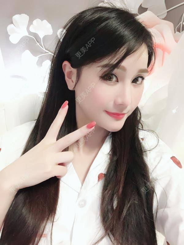 更美 - 肉圆子的酒窝经验 | 膨体垫下巴 | 自体脂肪垫下巴 | 硅胶垫下巴 | 人工骨垫下巴 | 酒窝 | 下巴 | 玻尿酸下巴 | 下巴截骨前移 | 酒窝成形 | 重庆 | 胶原蛋白丰下巴