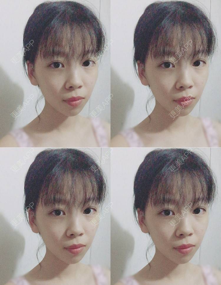 更美 - 更美用户JdH6xJ9jyW的乳晕缩小经验 | 乳晕缩小 | 上海
