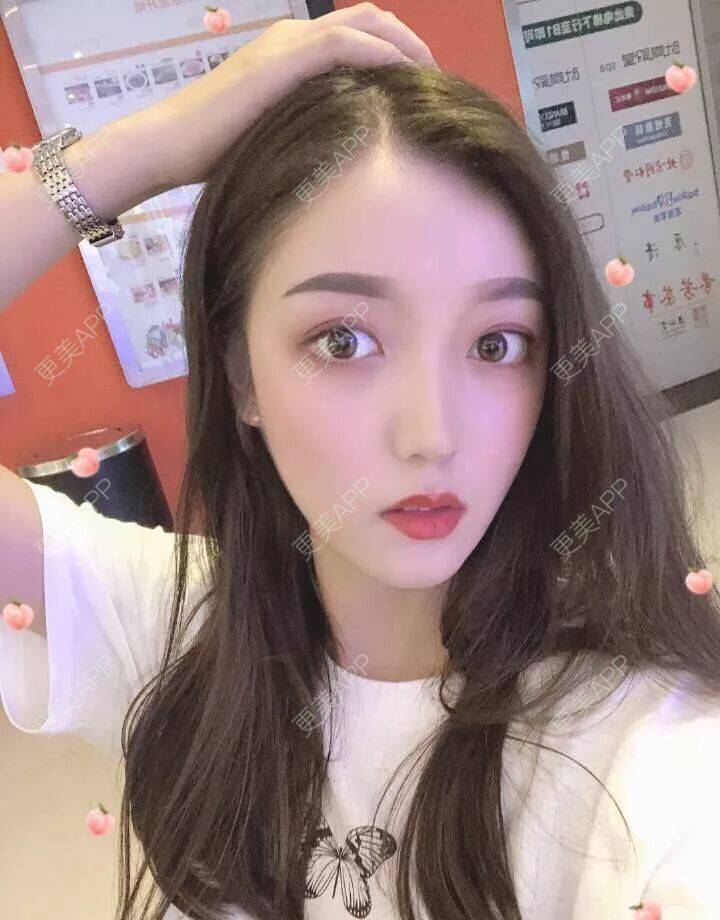 更美 - 艾泠的玻尿酸黑眼圈经验 | 玻尿酸黑眼圈