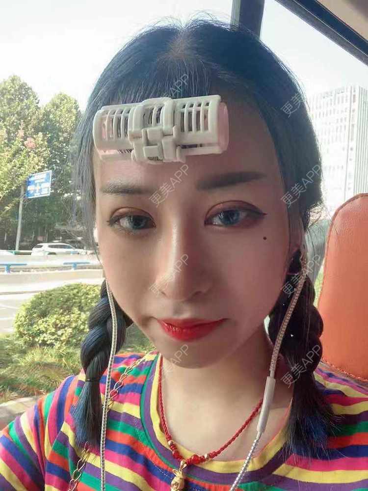 更美 - 饭冰冰儿的鼻部多项经验 | 鼻部多项 | 硅胶隆鼻 | 鹰钩鼻矫正 | 肋软骨隆鼻 | 鼻翼缩小