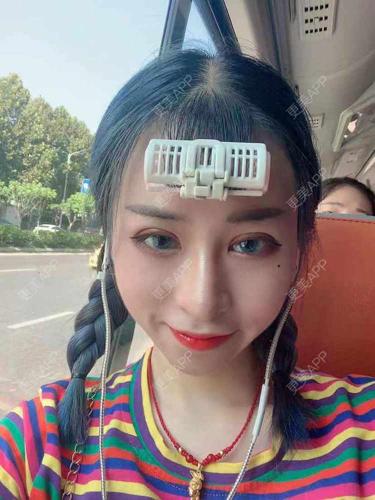 更美 - 饭冰冰儿的鼻部多项经验 | 鼻部多项 | 硅胶隆鼻 | 鹰钩鼻矫正 | 肋软骨隆鼻 | 鼻翼缩小