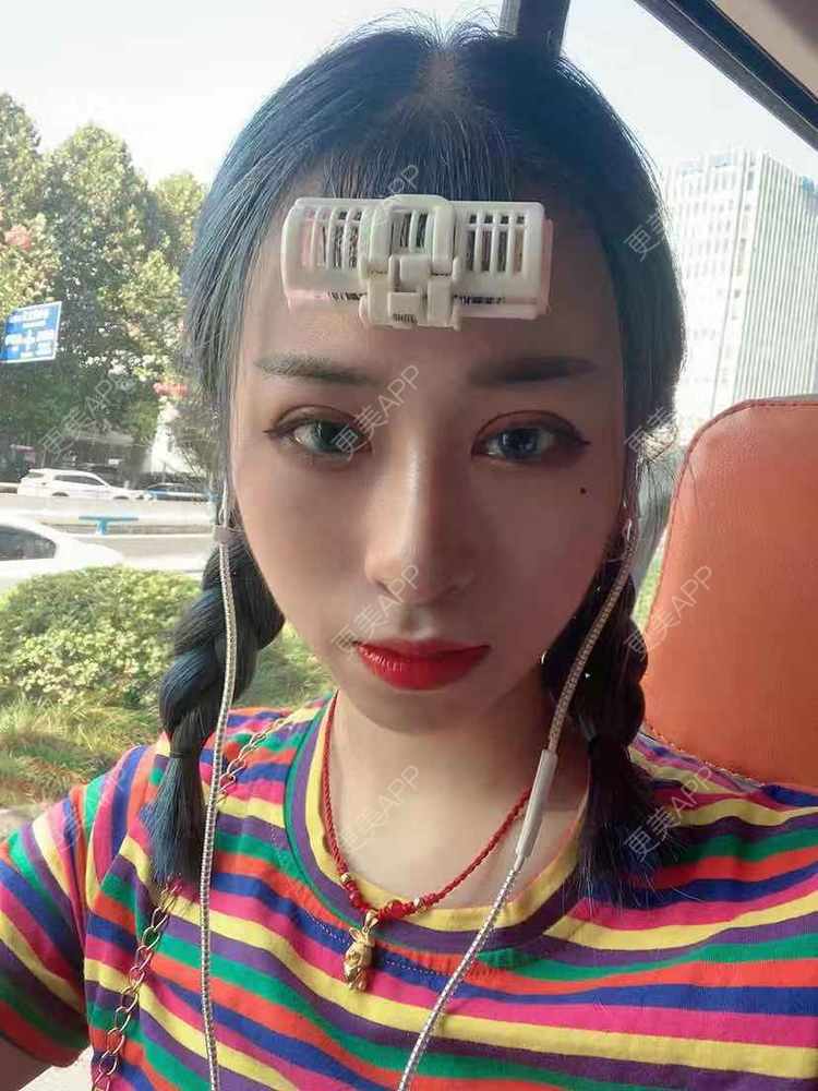 更美 - 饭冰冰儿的鼻部多项经验 | 鼻部多项 | 硅胶隆鼻 | 鹰钩鼻矫正 | 肋软骨隆鼻 | 鼻翼缩小